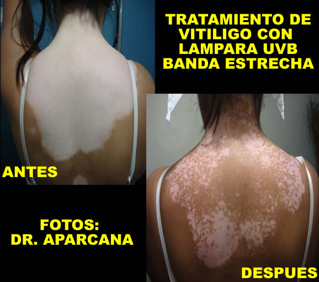 vitiligo-antes-y-despues-tratamiento-2 Vitiligo Antes y Depues del tratamiento