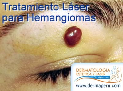 tratamiento-laser-hemangiomas Tratamiento Láser Hemangiomas