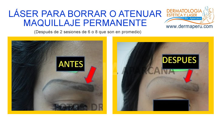 Atenuar Maquillaje Permanente Borrar o Atenuar Maquillaje Permanente