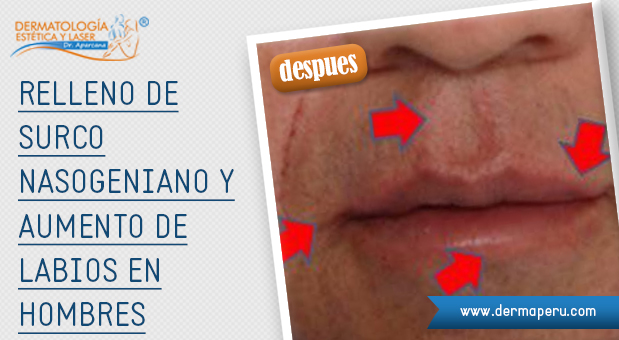 Relleno-de-Surco-nasogeniano-y-aumento-de-labios-en-hombres_3 Relleno-de-Surco-nasogeniano-y-aumento-de-labios-en-hombres_3