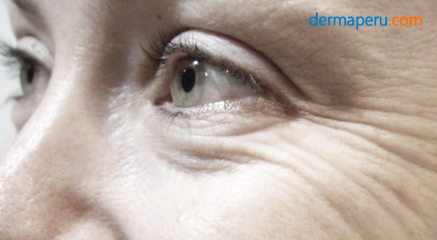 3-dermaperu-mejora-de-las-arrugas-con-toxina-butolinica2 3-dermaperu-mejora-de-las-arrugas-con-toxina-butolinica2