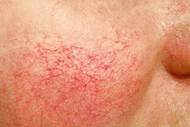 gtelangiectasia-tratamiento-dermaperu gtelangiectasia-tratamiento-dermaperu