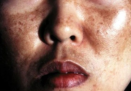 hipepigmentación-dermatologo-en-lima-tratamiento hipepigmentación-dermatologo-en-lima-tratamiento