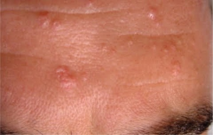 hiperplasia-sebacea-dermatoscopia-tratamiento-dermaperu-lima hiperplasia-sebacea-dermatoscopia-tratamiento-dermaperu-lima