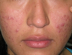 manchas-rojas-de-acne-dermaperu manchas-rojas-de-acne-dermaperu