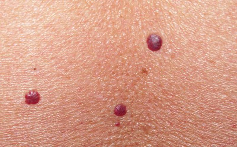 nevus-de-rubi-tratamiento-en-dermaperu nevus-de-rubi-tratamiento-en-dermaperu
