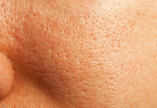 tratamiento-Poros-dilatados-en-lima-peru-dr-aparcana-dermaperu tratamiento-Poros-dilatados-en-lima-peru-dr-aparcana-dermaperu