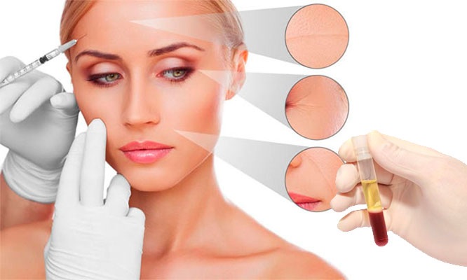 tratamiento-plasma-rico-en-plaquetas-lima-peru-dermaperu tratamiento-plasma-rico-en-plaquetas-lima-peru-dermaperu